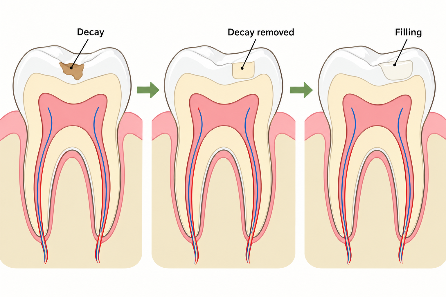 A small cavity is cleaned and restored with a tooth-colored filling.