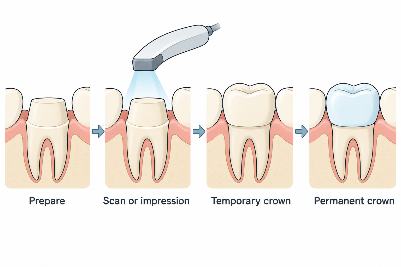 Crown preparation, recording the shape, a temporary crown, and fitting the permanent crown.