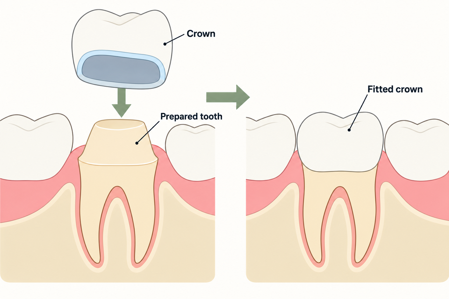A crown fits over a prepared natural tooth, whose roots remain in place.