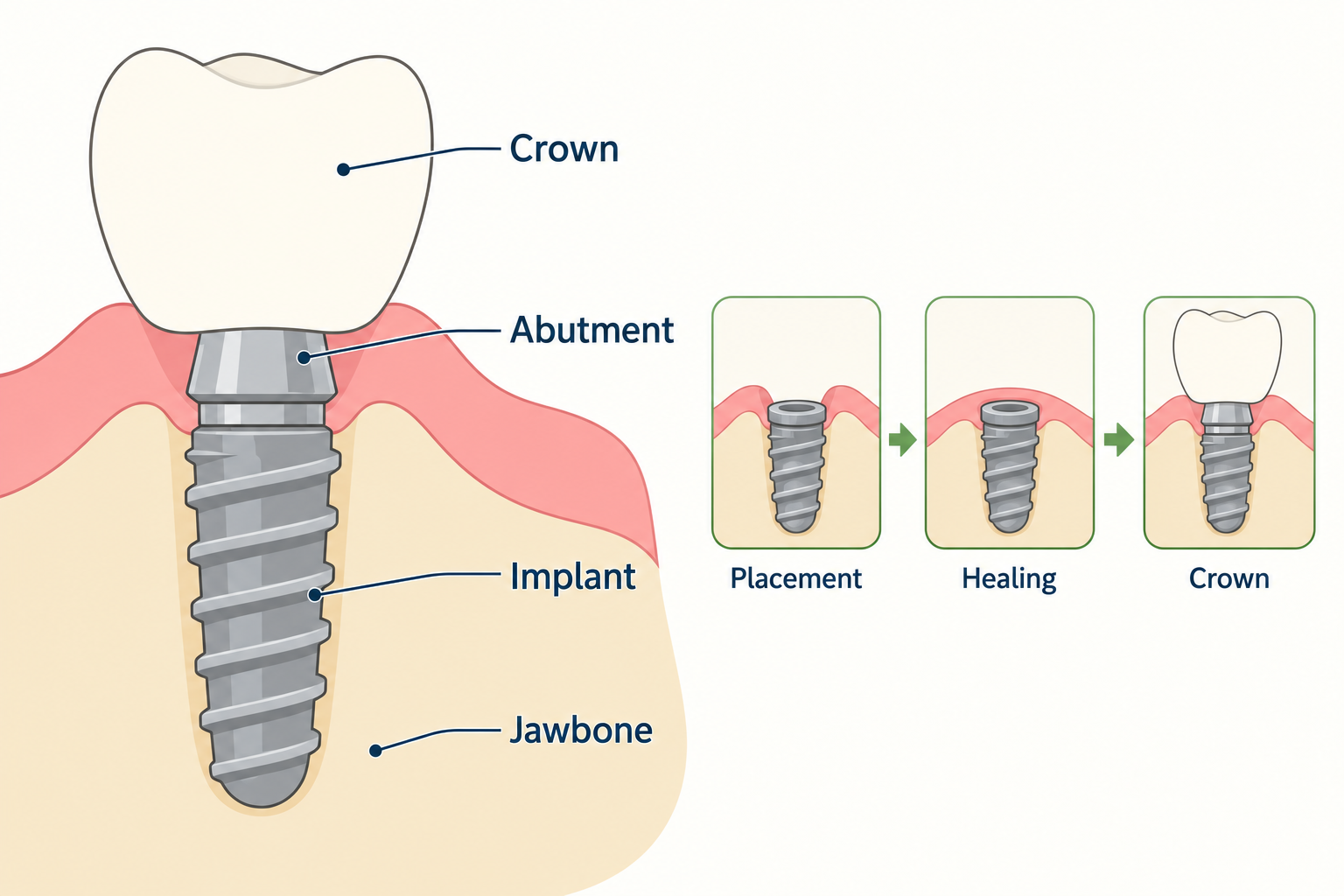 The crown connects to an implant in the jawbone through an abutment, after a healing period.