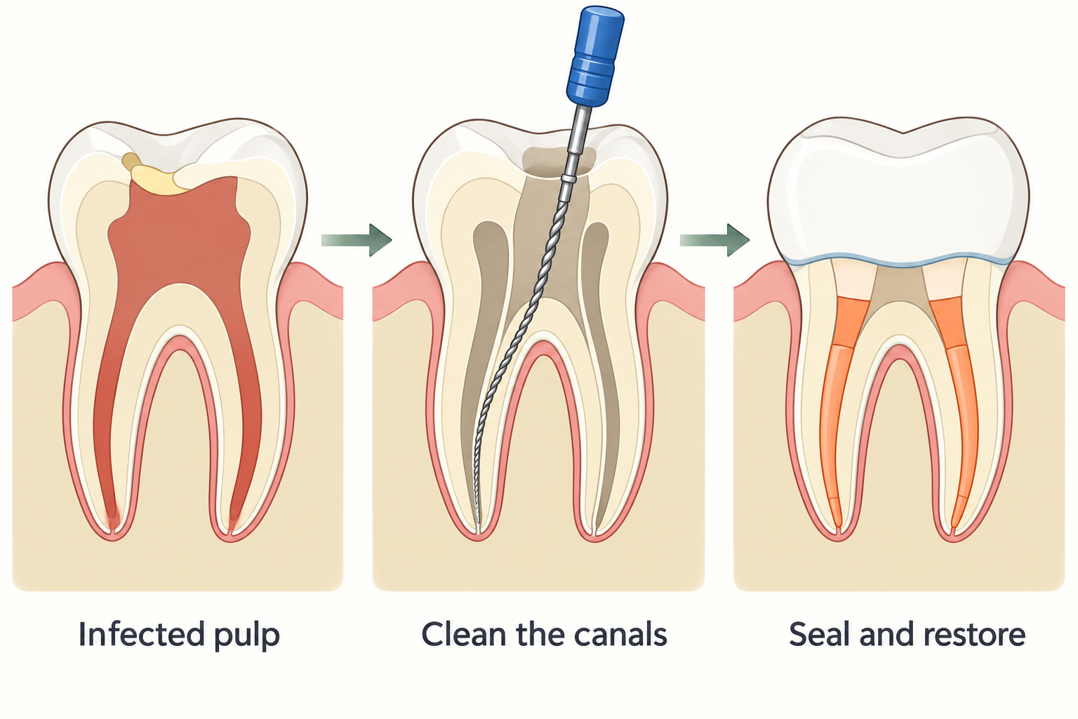 Infected pulp is removed from the internal root canals, which are cleaned, sealed, and followed by tooth restoration.