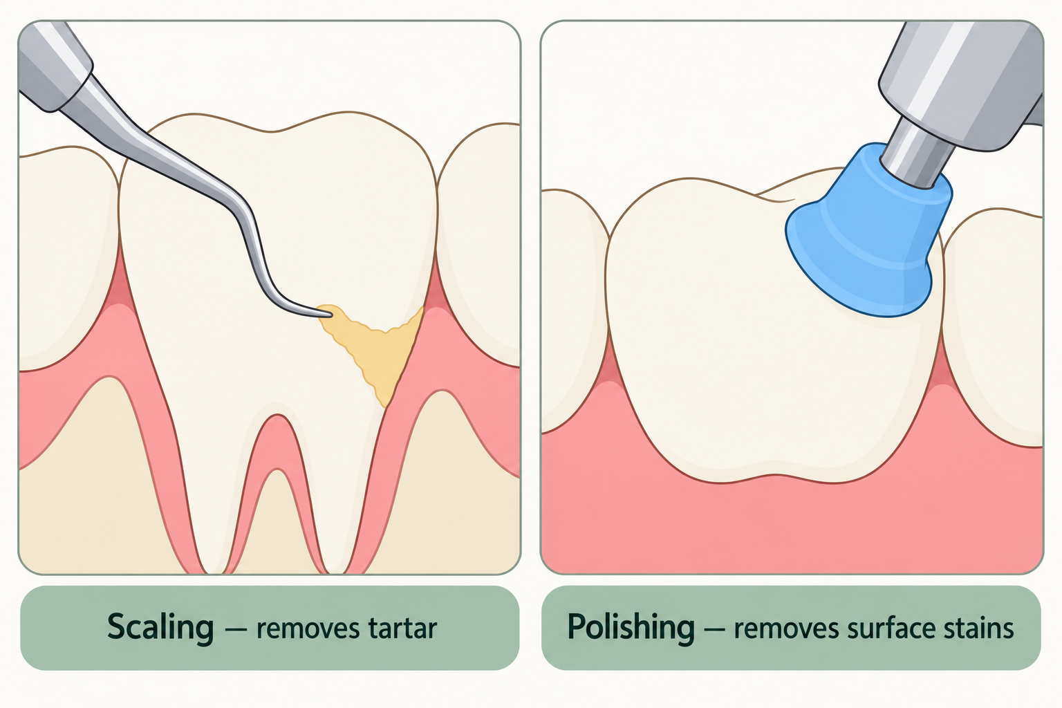 Scaling removes tartar, and a polishing cup removes surface stains from tooth surfaces.