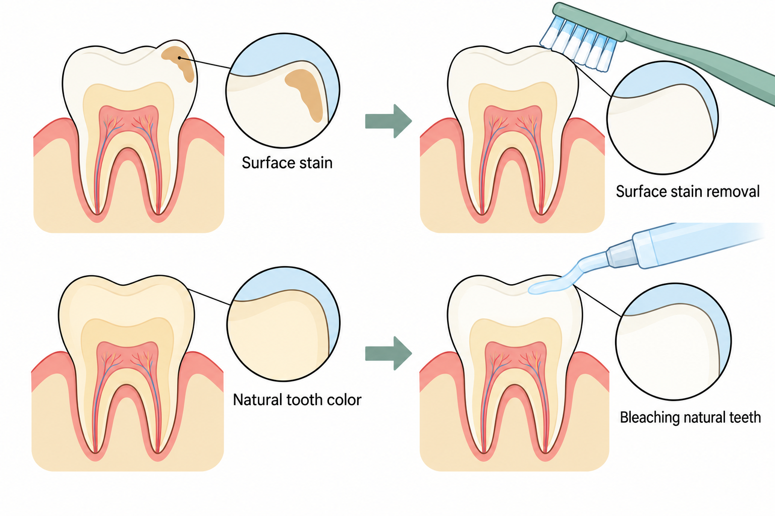 Surface stain removal cleans the outside of the tooth; peroxide bleaching can lighten natural tooth color.