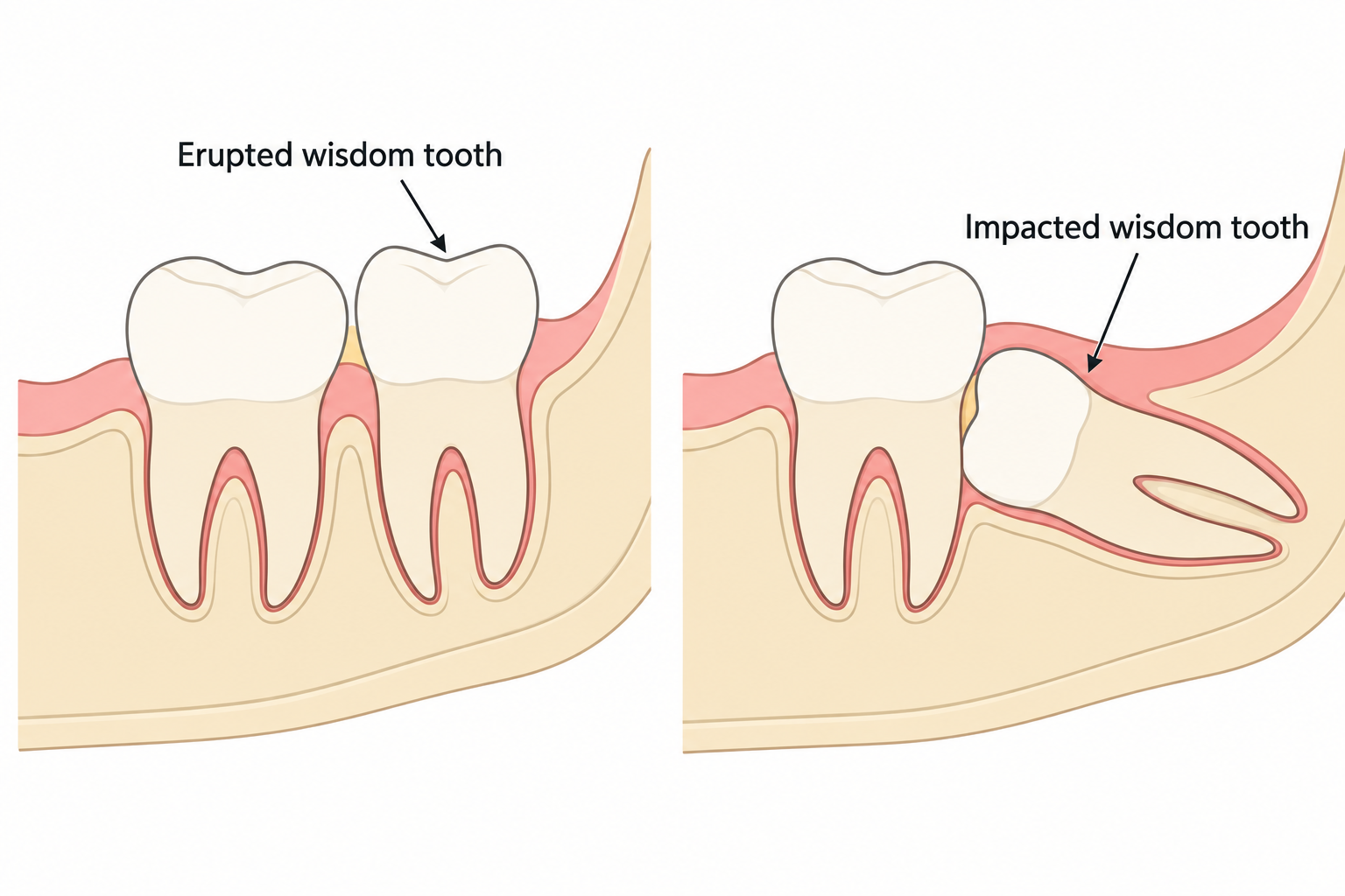 An upright erupted wisdom tooth compared with a sideways impacted wisdom tooth under the gum.